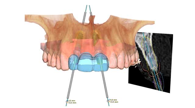 インプラントの設計に活用