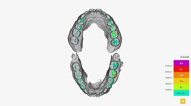 噛み合わせの確認