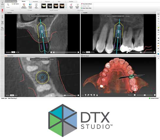 CT、口腔内スキャナ、設計システムの活用